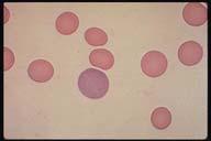 Images used by permission within AECOM domain 1998 American Society of Hematology unless otherwise noted.