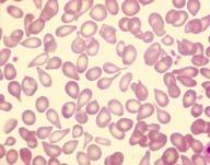 Description: Tear-drop shaped red blood cells.