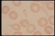 are seen. These are commonly observed in myelofibrosis, a variation of AMM.