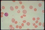 Description: Many microspherocytes are seen along with larger