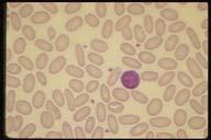 The finding of spherocytes on smear is not specifically diagnostic