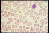 Description: The knobby red cells are called burr cells or echinocytes and are