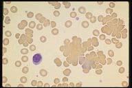 Acanthocytes in abetalipoproteinemia Description: In addition to burr and spurr