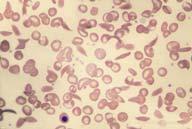 Description: Hb SS - Sickle Cell Anemia.
