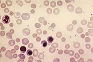 microspherocytes and shift retics among the normal RBCs. If hemolysis is severe, there may even be nucleated RBCs present.