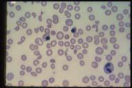 It is difficult to distinguish this smear from hereditary spherocytosis and more information about the patient is needed.