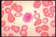 Description: There is no characteristic morphology diagnostic of idiopathic thrombocytopenic purpura (ITP). This field shows a giant platelet plus two regular sized platelets.