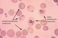 Description: Peripheral blood stained with New Methylene Blue which precipitates