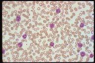 This is more indicative of a reactive leukocytosis rather than CML which would have many granulocytes at various