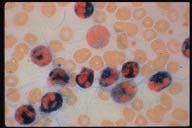 LAP Stain in reactive neutrophilia Description: This field shows the special histochemical stain leukocyte alkaline