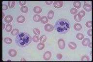 Description: The neutrophils have bluish inclusions in the cytoplasm called Dohle bodies.