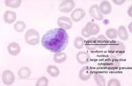 Reactive Monocyte Description: This ugly looking cell is not malignant.
