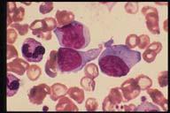Undifferentiated Blasts in Acute Leukemia Description: The blasts seen in this field have nucleoli but no granules in the