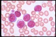 Acute Non-lymphocytic Leukemia-M1 Description: These typical blasts showing a nucleus, scant cytoplasm, round regular shape and