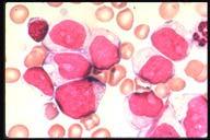Acute Myelogenous Leukemia with Auer Rods-ANNL M2 Description: The blasts in this field are more defined and contain granules.