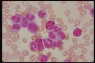 name. Description: AML M5 Acute monocytic leukemia.
