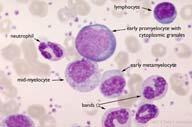 Description: Chronic myelocytic leukemia (CML).