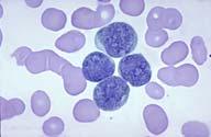 Acute Lymphocytic Leukemia-ALL L2 Description: Multiple undistinguished