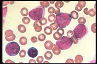 It is difficult to classify them as lymphoblasts because of a lack of
