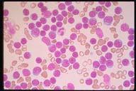 Description: The monotonous field of mature looking lymphocytes is typical of