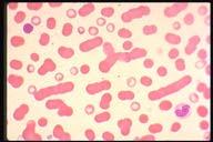 Rouleaux Description: Rouleaux formation of red cells as seen in inflammatory
