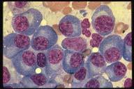 The abnormal clone of plasma cells shown are usually not seen in peripheral