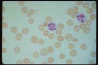 hypochromia, anisocytosis and poikilocytosis is