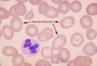 Megaloblastic Anemia Description: An eight lobed