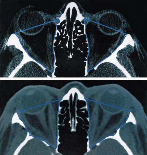 greater wing of sphenoid bone Inferior