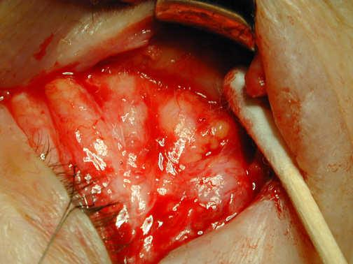 muscle Transconjunctival approach: Surgical Pearls Intra-septal plane: To maintain the same plane during dissection,