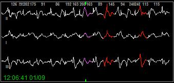 QRS morphology features, beats signal will be automatically