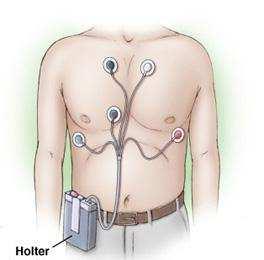 Process of Holter Analysis