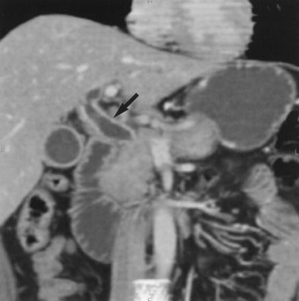 Dilatation of the common bile duct
