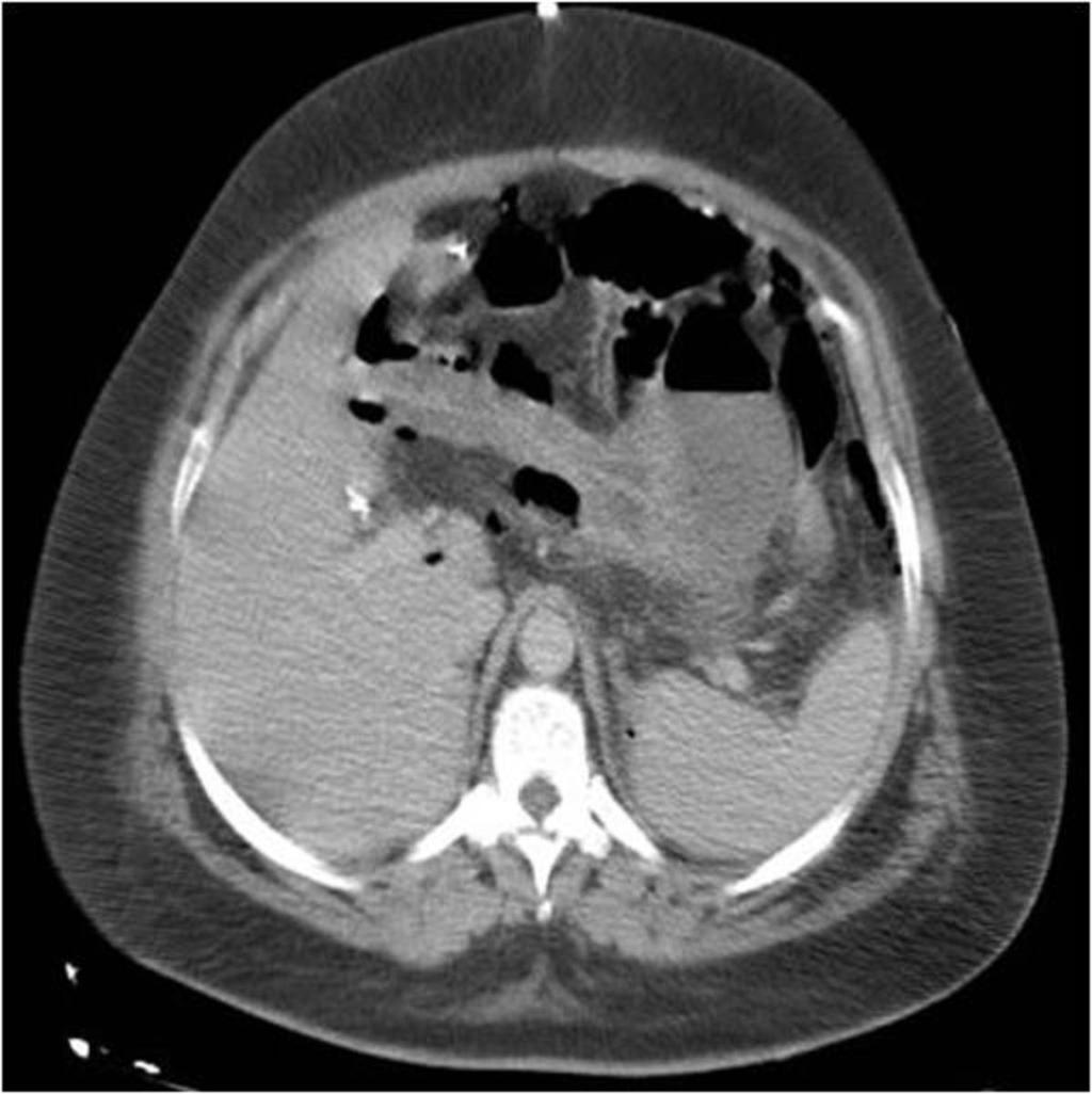 Fig. : Intraabdominal collection with hydroaereal