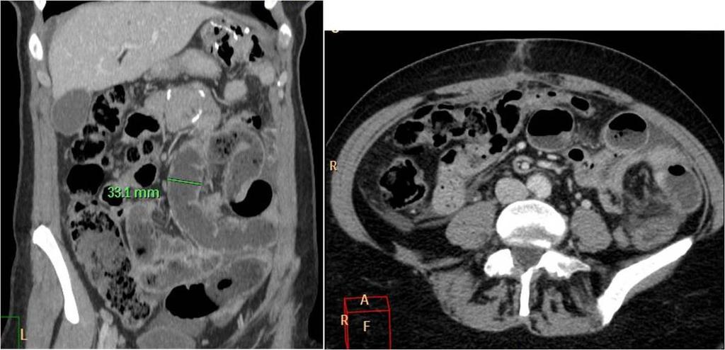 Fig. 3: Small bowel obstruction due to an adhesion.