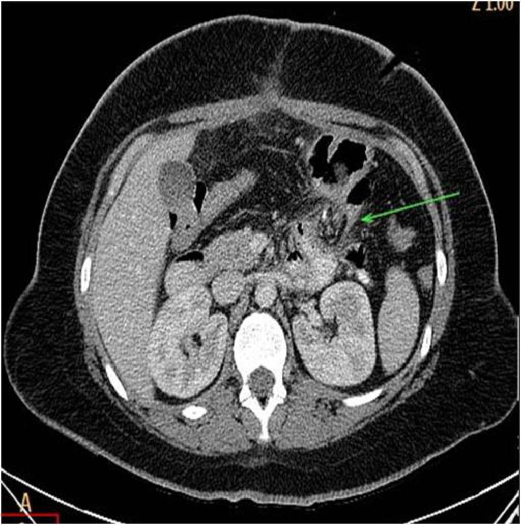 Fig. 5: Internal Hernia: CT scans show a abrupt mesenteric twist, with