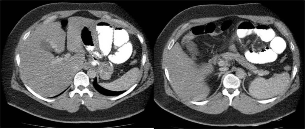 6: Internal Hernia: CT scans show a cluster of jejunal loops pressed againts