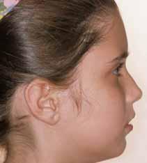 The patient s facial profile was slightly concave because of the soft-tissue