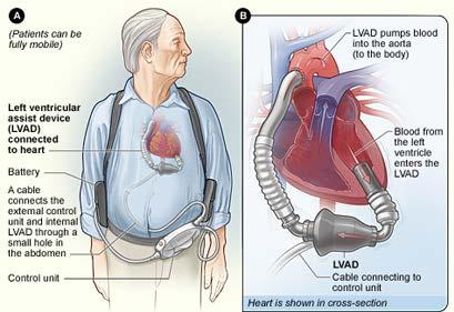 Advanced Therapies LVAD pump used for patients who have reached end-stage heart failure surgically implanted, it s a batteryoperated, mechanical pump, which then helps the left ventricle (main