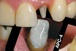 When a natural tooth is exposed through preparation, a variety of colors, as well as translucencies, are exposed that are mixed together in a layered effect.