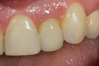 Figure 6: Post-cementation view with dehydration. The patient s shade matching was verified. Figure 7: Prior to dehydration, the crown restoration was checked for matching purposes.