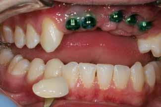 However, by using the Simple Enamel and Prep Color Guide (LSK Oral Prosthetics) to check calcification and occlusion color, the total effect was captured with a Ridge Only White OE (Occlusion Enamel)