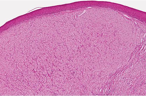 Histopathologic Features o Large, rounded cells o (Abundant granular, eosinophilic