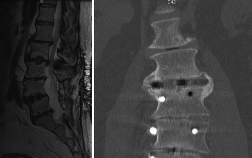 B: Postoperative anteroposterior radiograph after a minimally invasive lateral interbody fusion with plating. C and D: Measurement of preoperative and postoperative segmental lordosis angle.