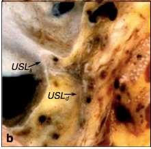 USL extends from S2 to S4 vertebra region to the dorsal margin of the uterine cervix and/or to the upper third of the posterior vaginal wall It has a superficial and deep
