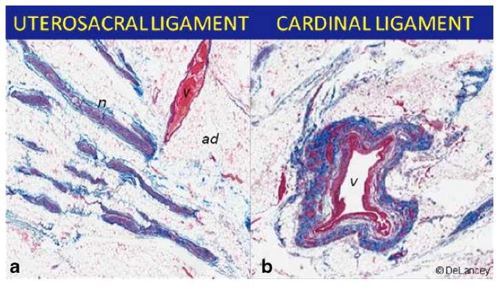 Histology of USL: Attenuated, poorly organized connective tissue Sparse collagen fibers Muscle fibers Scattered elastin beneath peritoneum Few fibroblasts Adipose tissue Cole et al Fig.