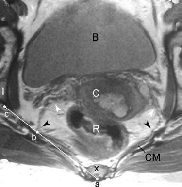 MRI of uterosacral ligament origin and insertion Figure 1. Axial scan at the level of the cervix. This image demonstrates the uterosacral ligament origins and insertions, and the measuring strategy.