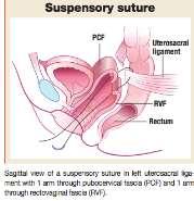 5 94.5 %) for the posterior segment Postoperative prolapse symptoms reported in 5 of the 11 studies