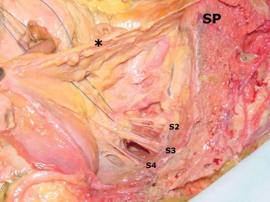 Suture entrapment of S2/S3 sacral nerves. Image of right hemipelvis with peritoneum reflected off of underlying structures (*). The S2, S3, and S4 sacral nerve roots are marked.
