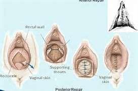 Is posterior vaginal wall prolapse repair more effective with a transanal or transvaginal incision?